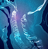 Injured cervical spine, CT scan