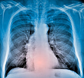 Thoracic aortic aneurysm, X-ray