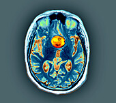 Aneurysm of the internal carotid artery, MRI scan