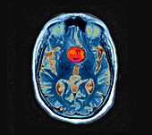 Aneurysm of the internal carotid artery, MRI scan