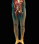 Aortoiliac occlusive disease, CT angiogram