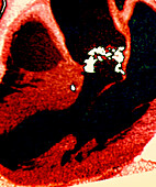 Heart valve disease, CT angiogram