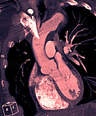 Healthy aortic valve, angiogram