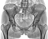 Healthy pelvis and hips, X-ray