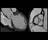 Aortic valve insufficiency, CT scans