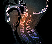 Odontoid process fracture, CT scan