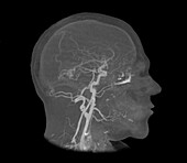 Brain haemorrhages, MRI angiogram