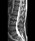 Schmorl nodules, MRI scan