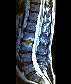 Schmorl nodules, MRI scan