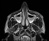 Sinusitis, MRI scan