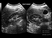 Normal gallbladder and kidney, ultrasound scans