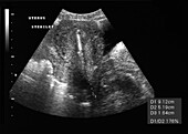 Healthy uterus, ultrasound scan