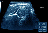 Healthy right hip of a baby, ultrasound scan