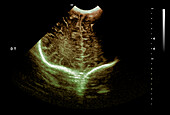 Normal premature newborn baby brain development, ultrasound