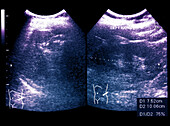 Normal spleen and left kidney, ultrasound scans
