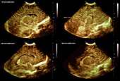 Premature baby normal brain development, ultrasound scans