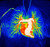 Heart and torso blood vessels, MRI angiogram