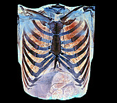Healthy rib cage, CT scan