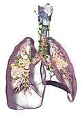 Lung cancer, illustration