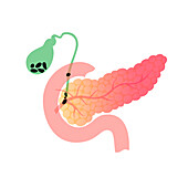 Pancreas and gallbladder with stones, illustration
