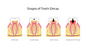 Stages of tooth decay, illustration