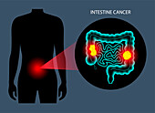 Colorectal cancer, illustration