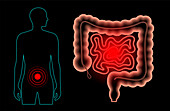 Intestinal disease, illustration