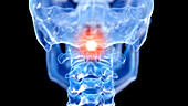 Painful atlas vertebrae, illustration