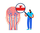Haemorrhagic stroke research, illustration