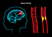 Ischaemic stroke, illustration