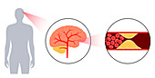 Ischaemic stroke, illustration