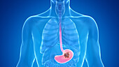 Stomach cancer, illustration