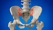 Arthritic sacroiliac joint, illustration