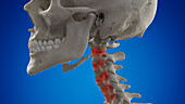 Arthritic cervical spine, illustration