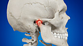 Inflamed temporomandibular joint, illustration