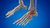 Arthritic foot, illustration