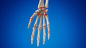 Arthritic hand, illustration