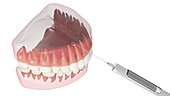 Dental anaesthesia, illustration