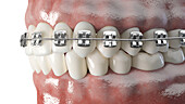 Dental braces, illustration