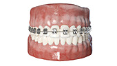 Dental braces, illustration