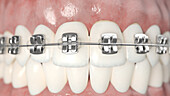 Dental braces, illustration