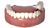 Dental bridge, illustration