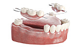 Dentures, illustration