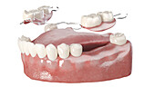 Dentures, illustration