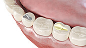 Different dental fillings, illustration