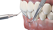 Gum graft surgery, illustration