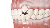 Impacted incisors, illustration