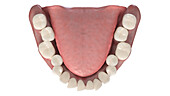 Overcrowded teeth, illustration