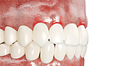 Periodontal disease, illustration