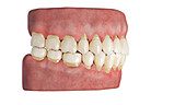 Periodontitis, illustration